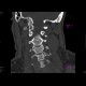 Fracture of occipital condyle: CT - Computed tomography